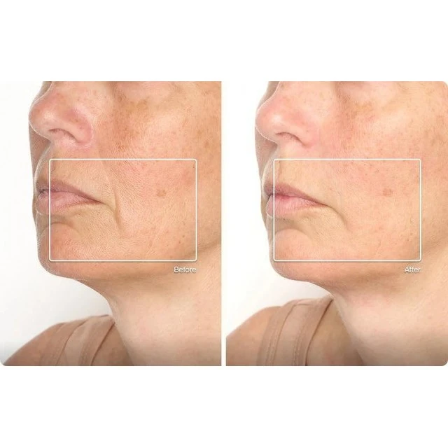 TheraFace Mask Glo - ЛЕД Маска за Лице | Вибрационна терапия